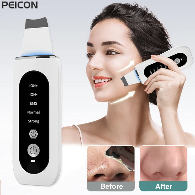 Ultrasonic Skin Scrubber - blackhead remover
